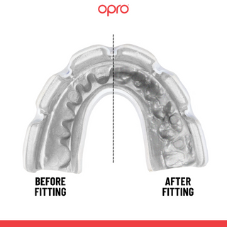 Opro Instant Custom Fit Braces Fitting